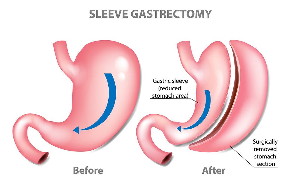 Gastric Sleeve Surgery